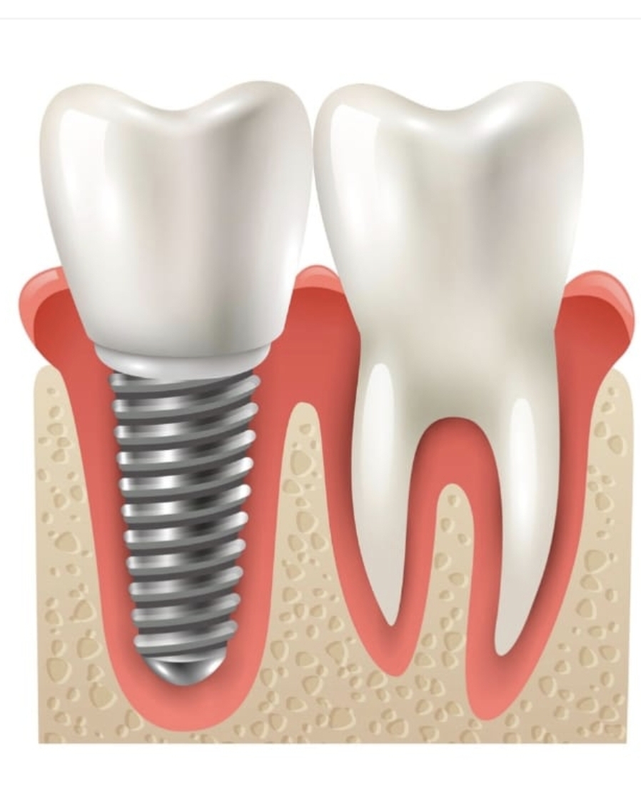 Implantology